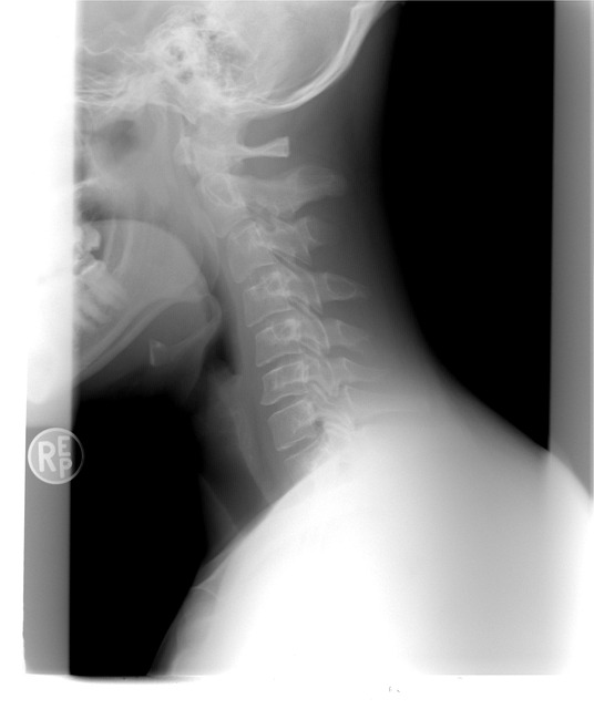 Chiropractic Spinal Alignment