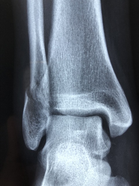 Digital Motion X-rays: Revolutionizing Auto Injury Diagnosis and Trauma Assessment