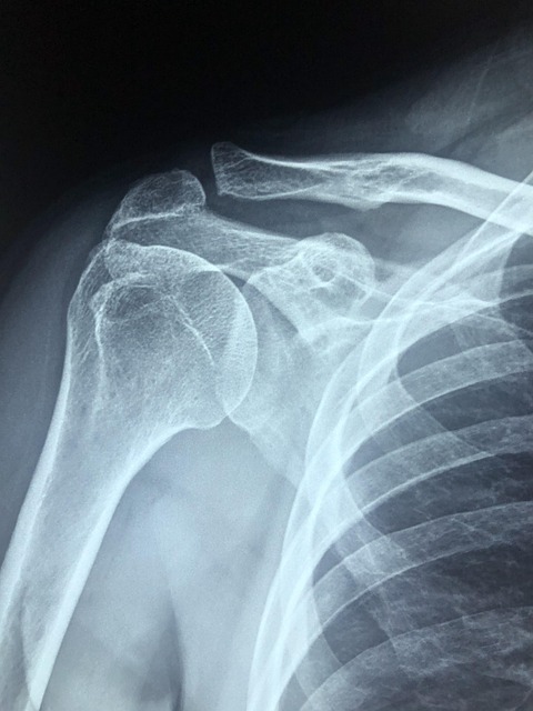 Shoulder Pain