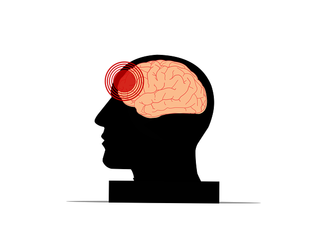 Migraine Headache