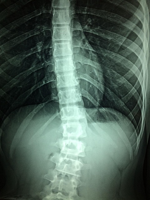 Spinal Alignment After Car Wreck: Comprehensive Evaluation Guide